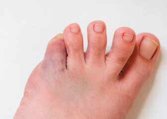 Foot with bruise on little toe