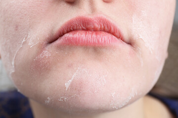 Woman with dry skin on face, closeup