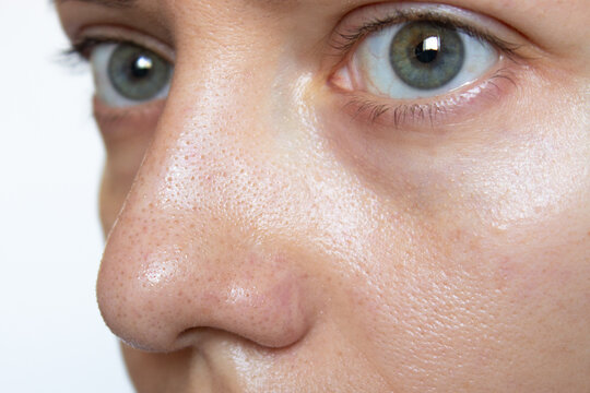 Close-up of a young woman's face with sweat and oily shine on her nose and cheeks. Large enlarged pores and blackheads on the skin of the face. Comedones, acne, hyperhidrosis. Facial skin problems