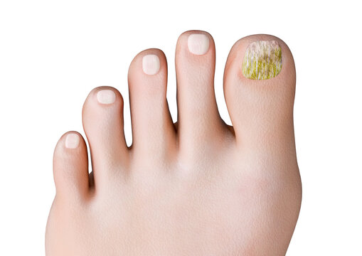 Onychomycosis is a nail infection caused by fungi, which feed on keratin, the protein that makes up most of the nails