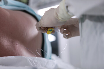 Epidural anesthesia in preparation for vascular surgery. Injections of spinal anesthesia. The concept of healthcare and medicine. - obrazy, fototapety, plakaty