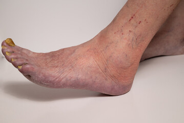 Closeup of a elderly woman foot with damaged nails because of fungus.Varicose veins on the womans legs