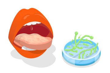 3D Isometric Flat  Conceptual Illustration of Oral Candidiasis, Yeast Infection