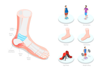 3D Isometric Flat  Conceptual Illustration of Heel Spur, Calcaneal Bone Condition - obrazy, fototapety, plakaty