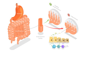 3D Isometric Flat  Conceptual Illustration of Celiac Disease, Educational Diagram - obrazy, fototapety, plakaty