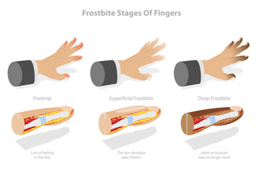 3D Isometric Flat  Conceptual Illustration of Frostbite Stages Of Fingers, Frozen Hands