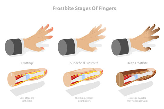 3D Isometric Flat  Conceptual Illustration of Frostbite Stages Of Fingers, Frozen Hands