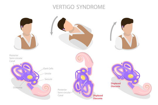 3D Isometric Flat  Conceptual Illustration of Vertigo Syndrome , BPPV