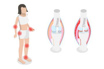 3D Isometric Flat  Conceptual Illustration of Rheumatism, Osteoarthritis and Rheumatoid Arthritis