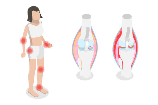 3D Isometric Flat  Conceptual Illustration of Rheumatism, Osteoarthritis and Rheumatoid Arthritis - Powered by Adobe