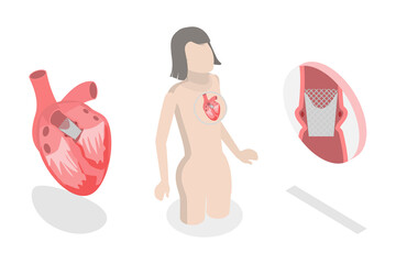 3D Isometric Flat  Conceptual Illustration of Transcutaneous Aortic Valve Replacement - TAVR, Minimally Invasive Surgery