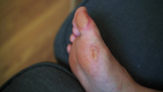 Close-up of a soft callus on a foot of a woman, sport shoes problem, corn on the leg. blister on the feet 