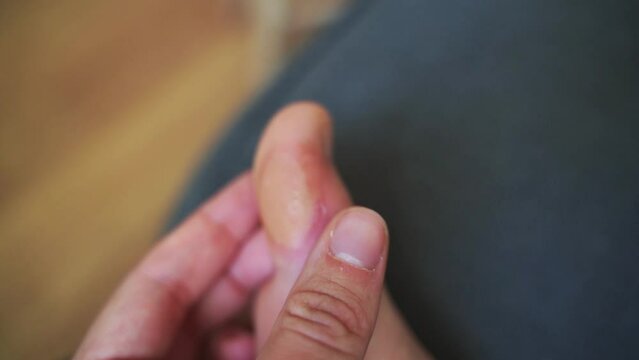Close-up of a soft callus on a foot of a woman, sport shoes problem, corn on the leg. blister on the feet 