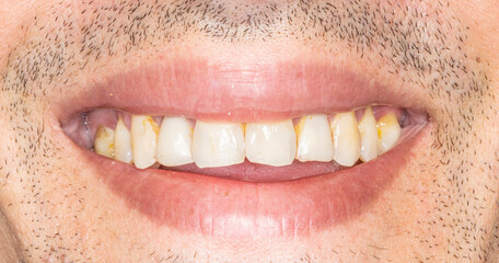 Close-up front view examination of a smiling unrecognizable man mouth open with yellowish teeth  colored spots because of smoking and bad hygiene, resin composite restorations. Beard hair and lips. 