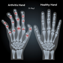 Rheumatoid arthritis and healthy human hands xray