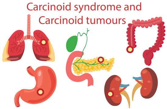 Carcinoid syndrome and carcinoid tumours,bowels,appendix,stomach, pancreas, lung, kidney,Carcinoid cancer awareness month concept,cancer,five
