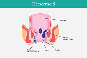 Cross section of the rectum and anal canal. illustration of hemorrhoids structure - obrazy, fototapety, plakaty