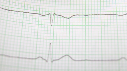 heart rhythm ekg note on paper doctors use to analyze heart disease treatment illustration on a white background