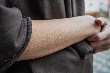 female hands with goosebumps on skin. cold and discomfort, heating and warmth.