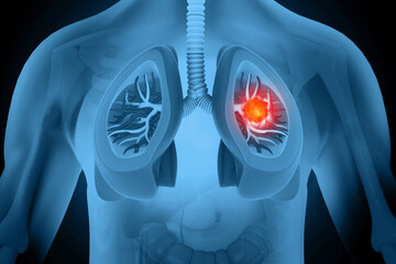 Medical Illustration showing lung cancer or bronchial carcinoma. 3d illustration - obrazy, fototapety, plakaty
