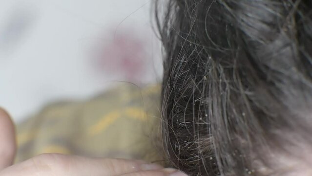 Seborrheic dermatitis can cause itching and hair problems
