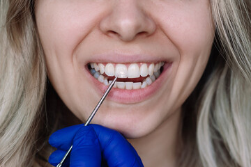 White spot on the tooth enamel. Doctor's hand in a blue glove pointing to young blonde woman's...