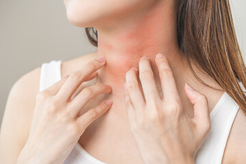 Dermatology concept, asian young woman, girl allergy, allergic reaction from atopic, insect bites on her neck, hand in scratching itchy, itch red spot or rash of skin. Health care, treatment of beauty - obrazy, fototapety, plakaty