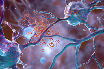 3d rendered illustration of neuron, dementia - obrazy, fototapety, plakaty
