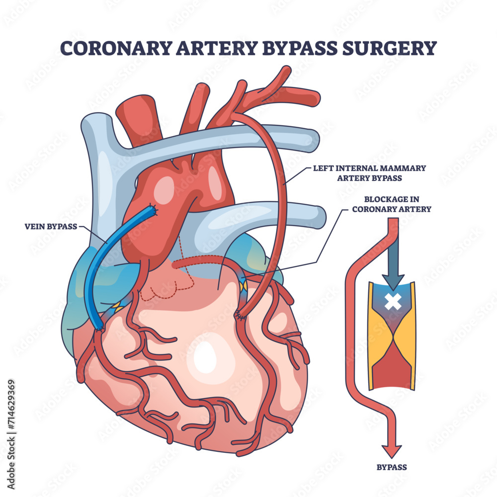 Wall mural Coronary artery bypass surgery for blocked blood flow outline diagram, transparent background. Labeled educational scheme with heart procedure and cardiology condition illustration.