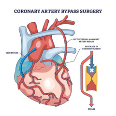 Coronary artery bypass surgery for blocked blood flow outline diagram, transparent background. Labeled educational scheme with heart procedure and cardiology condition illustration.