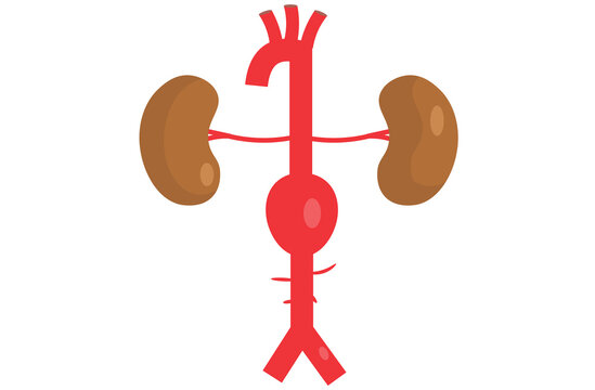 abdominal aortic aneurysm,heart aorta attack, aortic arch bulge open,vein clots stent stroke Marfan root left graft, hernia vessel pain High blood kidney damage Turner,red,pink,purple