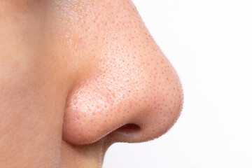 Close-up of a young woman's face with sweat and oily shine on her nose. Large enlarged pores and...