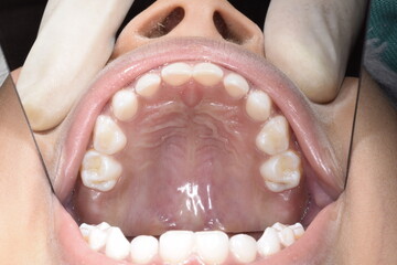 Upper maxillary arch occlusal indirect mirror view of a eight year old child dentition. Healthy...