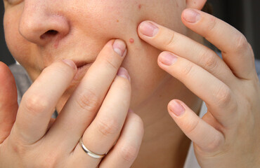 Close up of caucasian woman's face with scars, acne skin problems