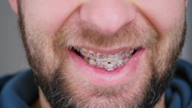 Adult Caucasian Male with Serious Malocclusion of Chipped and Damaged Teeth with Metal Dental Braces For Orthodontic Treatment