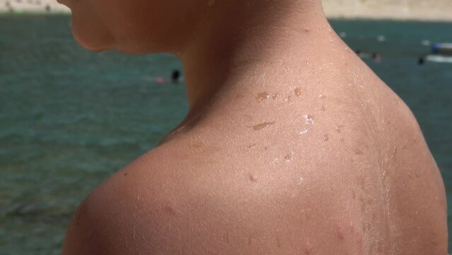 Akcagerme Beach, Kas, Turkey - 7th of September 2023: 4K Itching rush on the body of a boy on vacation, close up
