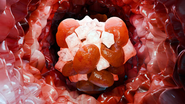 Depiction of Blood clot,  thrombus in vein, Thrombosis, cardiovascular system, red blood cells stream, activated platelets and fibrin, Arterial embolism or embolus, vascular pathology, 3d render 