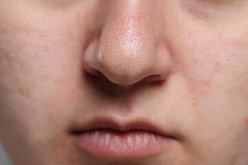 Fototapeta premium Closeup view of woman with comedones on her nose
