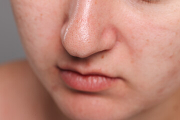 Fototapeta premium Closeup view of woman with comedones on her nose