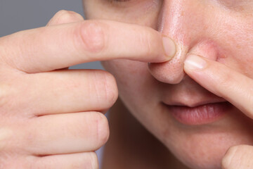 Woman popping pimple on her nose against grey background, closeup