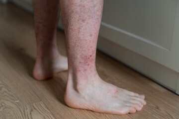Close-up of man's leg barefoot on the floor with dermatitis rush and red irritation on the skin.