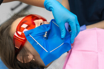 Process of installing a dental cofferdam for dental treatment on the jaw of a young woman wearing protective glasses in dentistry. Dentist uses a dental dam to isolate the tooth