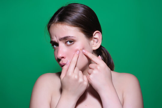 Sad Woman squeeze out pimples on cheek. Acne and pimple on skin. Dermatology, puberty woman. Pimples problem skin. Girl Squeeze out Pimple on skin cheek. Care from skin problem. Pimple face.