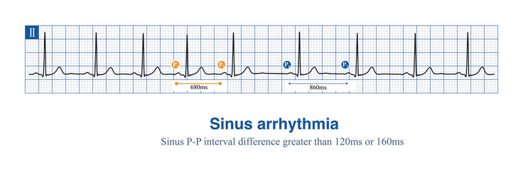 Sinus arrhythmia is a very common benign arrhythmia that does not require treatment. It can be diagnosed with a sinus cycle difference of more than 120ms or 160ms.