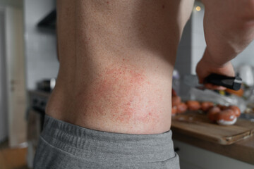 Close-up of man's body belly at home in kitchen with dermatitis rush and red irritation on the skin.