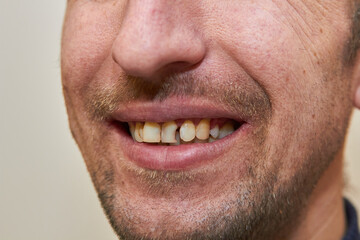 Obraz premium smile with a broken tooth close-up, man with stubble smiling with open mouth, broken tooth, spilled dental filling