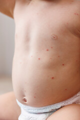 Fototapeta na wymiar Toddler boy's skin covered with chickenpox blisters