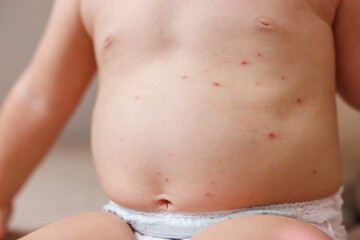 Detail of baby's skin covered with smallpox blisters
