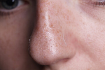 Woman with dry skin on nose, macro view