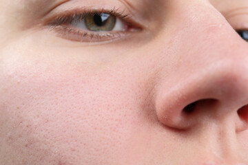 Fototapeta na wymiar Woman with dry skin on face, closeup